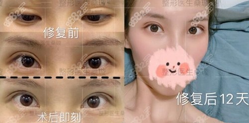 我可以带着节育环做供卵做试管婴儿吗？