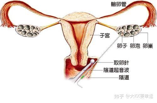 结扎后可以做试管