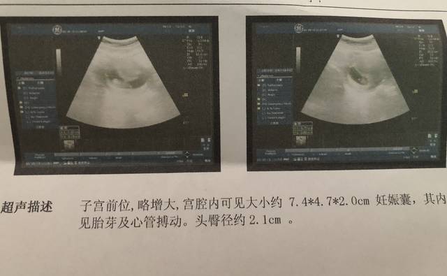 试管供卵试管代怀明细移植后,注意和禁忌